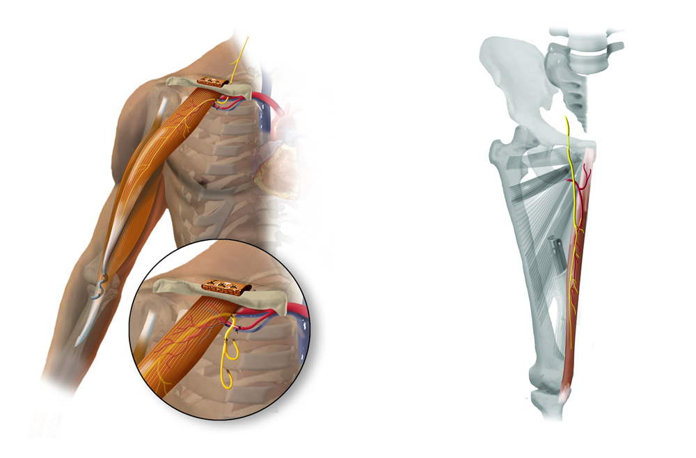 Illustration of Gracilis functional free muscle transfer surgery 